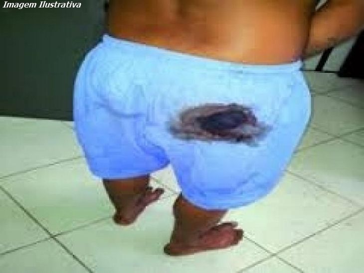 baleado na-bunda