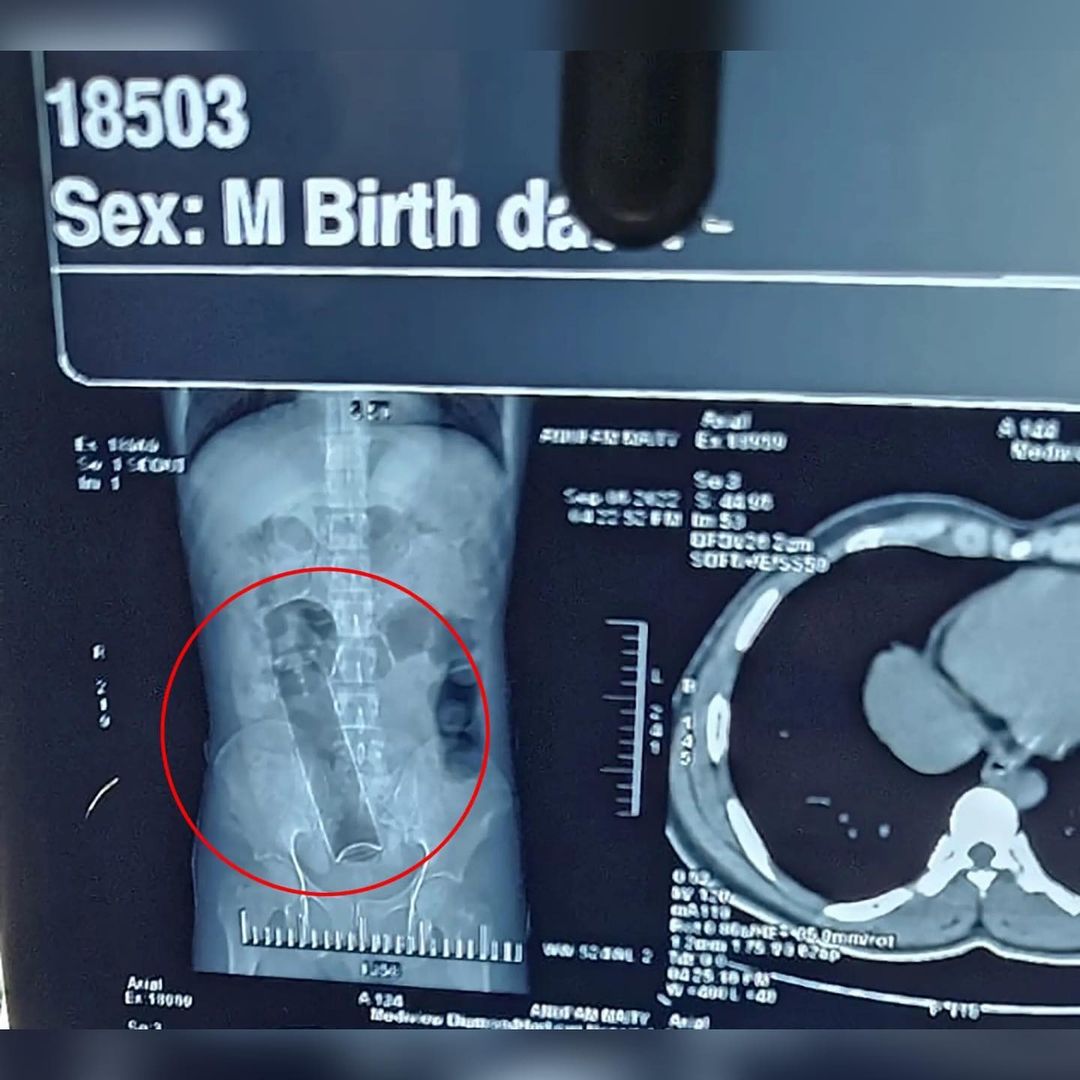 cirurgia no anus